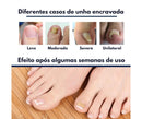 Adesivo TOENAIL™ - Desencrava Unhas e Elimina Micoses✅