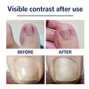 Adesivo TOENAIL™ - Desencrava Unhas e Elimina Micoses✅